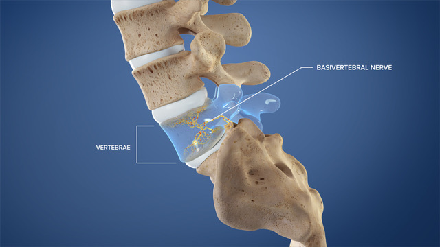 low back pain after a car accident
