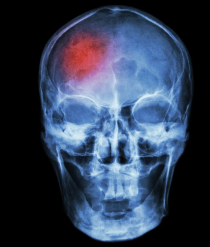 tbi after a car accident kansas city